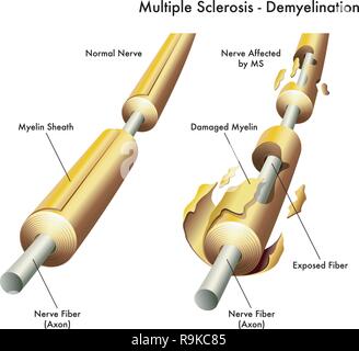 Comparaison 3d illustration médicale nerf sain avec une étiquette avec les dommages causés par la sclérose en plaques. Illustration de Vecteur