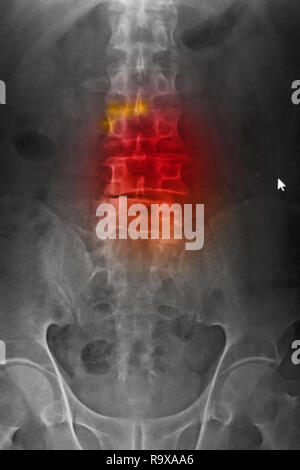 La radiographie numérisée (CR) d'lumbosarcal antéropostérieur rachis(AP) montrant la spondylolyse et rachis scoliose. Banque D'Images