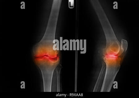 L'arthrose du genou gauche film x-ray (AP - antérieure du genou postérieur) montrent l'espace mixte étroit . Banque D'Images