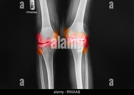 L'arthrose du genou droit film x-ray (AP - antérieure du genou postérieur) montrent l'espace mixte étroit . Banque D'Images