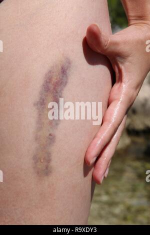 Cuisse grave bleu sur la jambe d'une jeune femme. Droit Médical - contusion, hématome de tissu. Banque D'Images