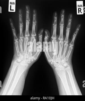 X-ray des deux mains humaines.normal des mains humaines. Banque D'Images