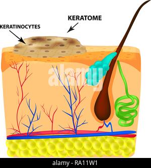 La structure de l'keratoma. Actinique. La structure des grains de beauté sur la peau. L'infographie. Vector illustration sur fond isolé Illustration de Vecteur