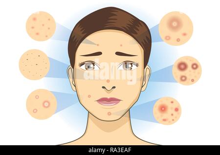 Tous les types de l'acné, la peau du visage de l'icône de la femme. Illustration de Vecteur