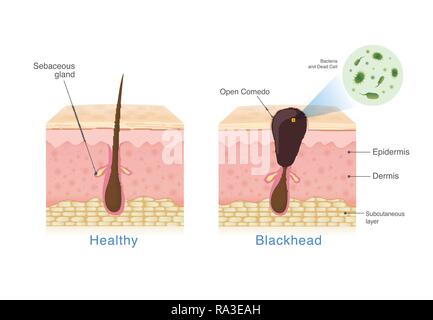 Les bactéries dans la tête noire avec de la peau humaine de la structure de la couche et la peau saine. Illustration de Vecteur