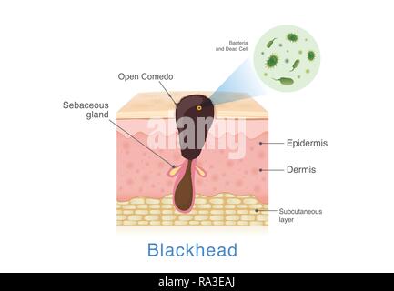 Les bactéries dans le point noir avec couche de peau humaine de la structure. Illustration de Vecteur