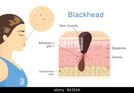 Femme a la tête noire acné sur son nez avec couche de peau et de description. Illustration de Vecteur