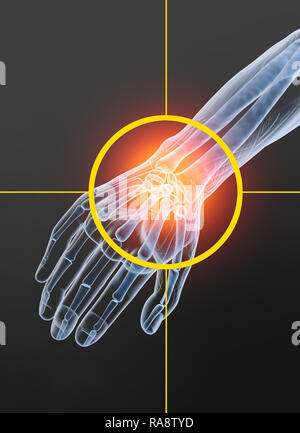 L'arthrite rhumatoïde articulation du poignet, médicalement illustraion 3D Banque D'Images