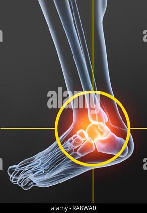L'arthrose de la cheville, 3D illustration Banque D'Images