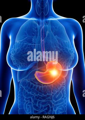 Illustration d'une femme de l'inflammation de l'estomac. Banque D'Images
