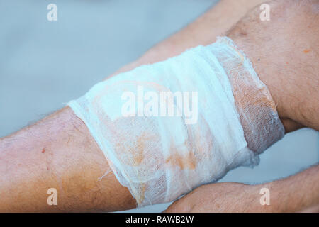 Processus d'application d'un bandage sur la jambe malade libre, desmurgy Banque D'Images