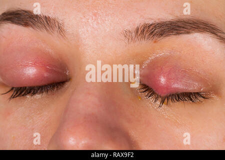 Close up photo de l'inflammation des paupières supérieures - chalazion - jeunes femmes souffrant d'une infection virale Banque D'Images