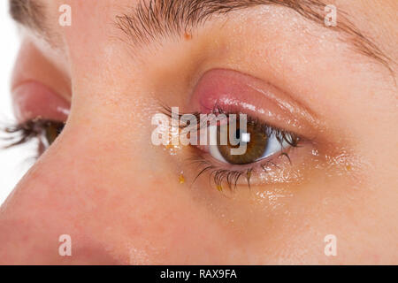 Close up photo de l'inflammation des paupières supérieures - chalazion - jeunes femmes souffrant d'une infection virale Banque D'Images