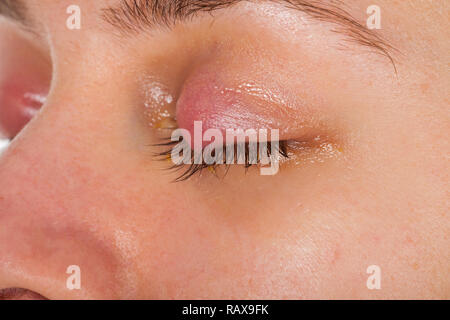 Close up photo de l'inflammation des paupières supérieures - chalazion - jeunes femmes souffrant d'une infection virale Banque D'Images