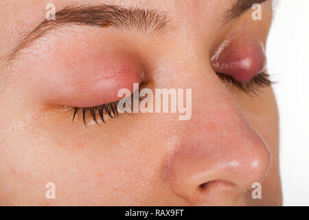 Close up photo de l'inflammation des paupières supérieures - chalazion - jeunes femmes souffrant d'une infection virale Banque D'Images