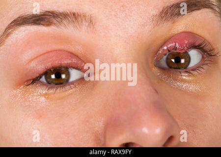 Close up photo de l'inflammation des paupières supérieures - chalazion - jeunes femmes souffrant d'une infection virale Banque D'Images