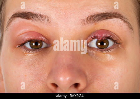 Close up photo de l'inflammation des paupières supérieures - chalazion - jeunes femmes souffrant d'une infection virale Banque D'Images