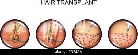 Illustration vecteur de transplantation de cheveux Alopécie. tête. Illustration de Vecteur