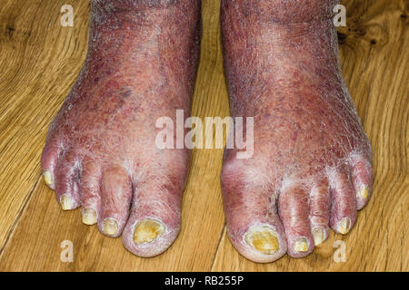 L'infection à champignon sur les ongles de pied de l'Homme Banque D'Images