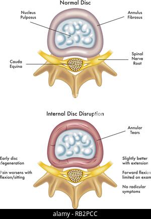 Medical illustration des effets des perturbations internes disc Illustration de Vecteur