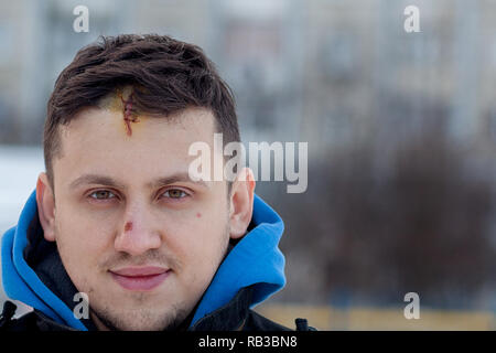 Blessure au crâne avec Suture, fils de couture craniectomy postopératoire avec beaucoup d'agrafes, de la technologie médicale la couture. Banque D'Images