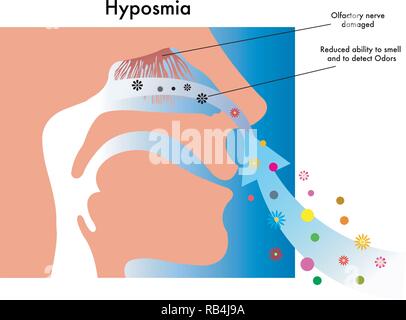 Illustration médicale symbolique de symptômes d'hyposmia Illustration de Vecteur