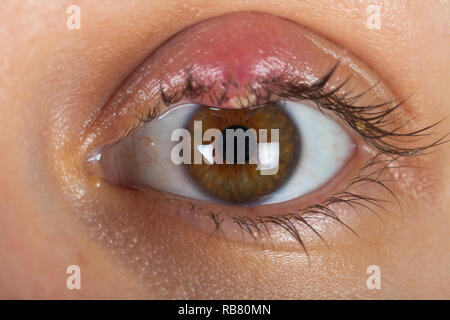 Close up photo de femme oeil infecté du patient. Sur Orgelet paupière supérieure. L'infection virale. Staphylococcus Banque D'Images