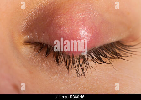 Close up photo de femme oeil infecté du patient. Sur Orgelet paupière supérieure. L'infection virale. Staphylococcus Banque D'Images