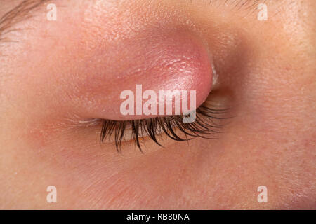 Close up photo de femme oeil infecté du patient. Sur Orgelet paupière supérieure. L'infection virale. Staphylococcus Banque D'Images