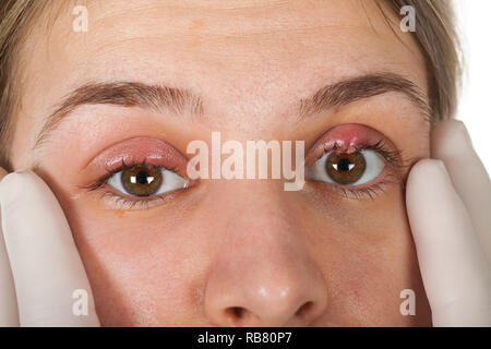 Close up photo de femme oeil infecté du patient. Sur Orgelet paupière supérieure. L'infection virale. Staphylococcus Banque D'Images