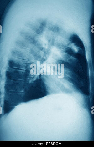 Le CANCER DU POUMON X-RAY Banque D'Images