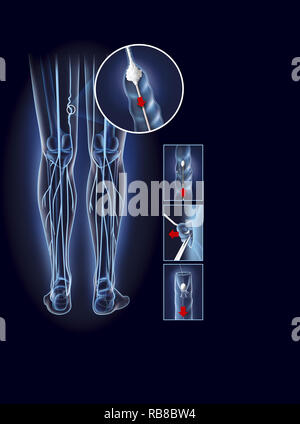 Traitement des varices, ILLUSTRATION Banque D'Images