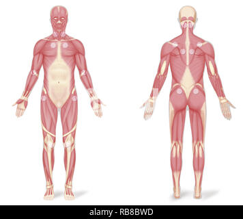 La fibromyalgie, dessin Banque D'Images