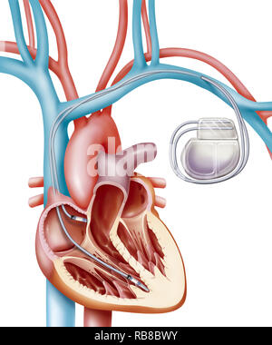 STIMULATEUR CARDIAQUE Banque D'Images