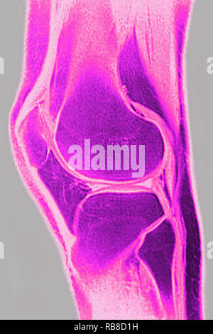 Genou normal vu sur une coupe sagittale IRM. Banque D'Images