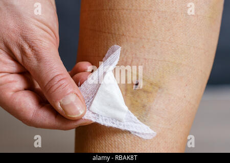 Woman bandages et l'inspection de sa jambe après chirurgie des varices, avec blessures visibles. Le traitement curatif, procédures esthétiques, thrombose Banque D'Images