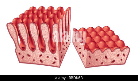 La maladie coeliaque La maladie coeliaque ou concept médical anatomie normale et avec les villosités de l'intestin grêle endommagé comme doublure d'une maladie auto-immune de la digestion. Banque D'Images