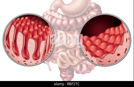 La maladie cœliaque la maladie coeliaque ou intestin anatomie medical concept avec villi normal et de l'intestin grêle endommagé comme doublure d'une maladie auto-immune. Banque D'Images