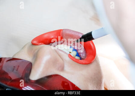 Patient avec des lunettes de sécurité et de l'enrouleur sur la joue. Lampe lumière laser activer comme une procédure de blanchiment des dents professionnels. Cosmétiques et esthétiques des femmes Santé Soins dentaires Blanchiment des dents saines.Concept intérieur. Banque D'Images