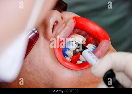 Patient avec des lunettes de sécurité et de l'enrouleur sur la joue. Lampe lumière laser activer comme une procédure de blanchiment des dents professionnels. Cosmétiques et esthétiques des femmes Santé Soins dentaires Blanchiment des dents saines.Concept intérieur. Banque D'Images