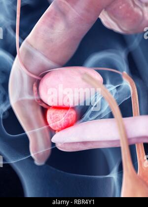 Illustration d'une inflammation du pancréas. Banque D'Images