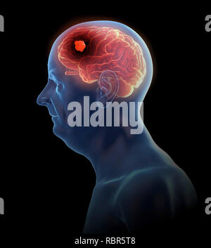 Illustration d'une tumeur au cerveau. Banque D'Images