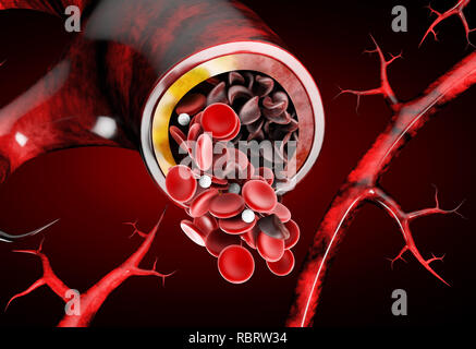 La drépanocytose, montrant vaisseau sanguin normal et deformated avec crescent 3D illustration. Banque D'Images