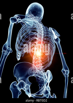 Illustration d'un rachis douloureux. Banque D'Images