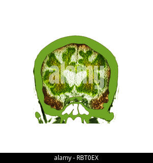 Le cerveau dans la démence. La tomographie de couleur (CT) d'une section à travers le cerveau d'un 89-year-old male patient souffrant de démence. Le cerveau a atrophiées (réduites), illustré par les ventricules centrale élargie et entailles profondes autour des bords du cerveau. Banque D'Images