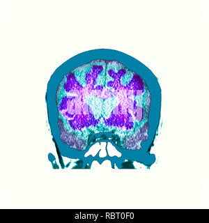 Le cerveau dans la démence. La tomographie de couleur (CT) d'une section à travers le cerveau d'un 89-year-old male patient souffrant de démence. Le cerveau a atrophiées (réduites), illustré par les ventricules centrale élargie et entailles profondes autour des bords du cerveau. Banque D'Images