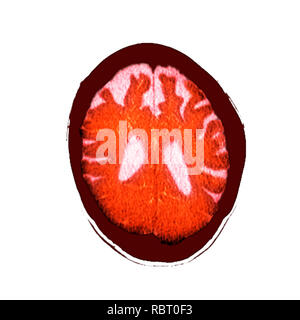 Le cerveau dans la démence. La tomographie de couleur (CT) d'une section à travers le cerveau d'un 89-year-old male patient souffrant de démence. Le cerveau a atrophiées (réduites), illustré par les ventricules centrale élargie (blanc) et d'entailles profondes autour des bords du cerveau. Banque D'Images