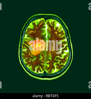 Glioblastome cancer du cerveau. La tomographie de couleur (CT) d'une section à travers le cerveau d'un 84-year-old female patient avec glioblastome (sombre, à gauche). Le glioblastome est la forme la plus agressive de cancer du cerveau. Le traitement implique la chirurgie, après quoi la chimiothérapie et la radiothérapie sont utilisées. Cependant, le cancer habituellement se produit malgré le traitement le plus courant et la durée de survie après le diagnostic est de 12 à 15 mois. Sans traitement, la survie est généralement 3 mois. Banque D'Images