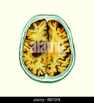 Glioblastome cancer du cerveau. La tomographie de couleur (CT) d'une section à travers le cerveau d'un 84-year-old female patient avec glioblastome (sombre, à gauche). Le glioblastome est la forme la plus agressive de cancer du cerveau. Le traitement implique la chirurgie, après quoi la chimiothérapie et la radiothérapie sont utilisées. Cependant, le cancer habituellement se produit malgré le traitement le plus courant et la durée de survie après le diagnostic est de 12 à 15 mois. Sans traitement, la survie est généralement 3 mois. Banque D'Images