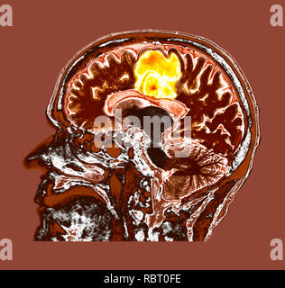 Glioblastome cancer du cerveau. La tomographie de couleur (CT) d'une section à travers le cerveau d'un 84-year-old female patient avec glioblastome (jaune, en haut). Le glioblastome est la forme la plus agressive de cancer du cerveau. Le traitement implique la chirurgie, après quoi la chimiothérapie et la radiothérapie sont utilisées. Cependant, le cancer habituellement se produit malgré le traitement le plus courant et la durée de survie après le diagnostic est de 12 à 15 mois. Sans traitement, la survie est généralement 3 mois. Banque D'Images